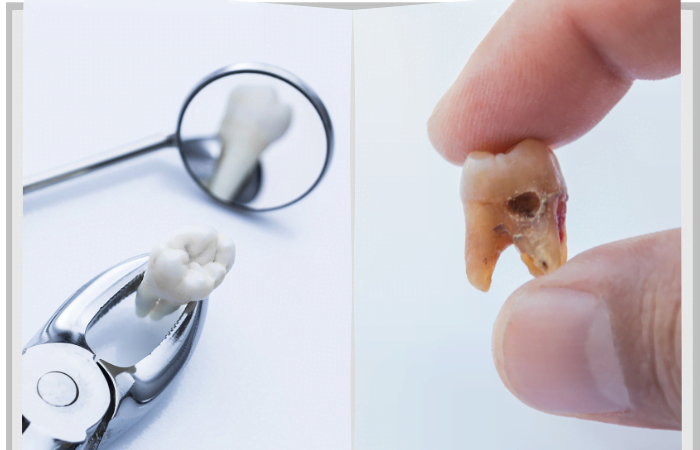 wisdom tooth & tooth decay